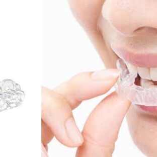 マウスピースの洗浄と保管方法