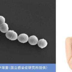 劇症型溶連菌感染の初期症状と予防および治療法